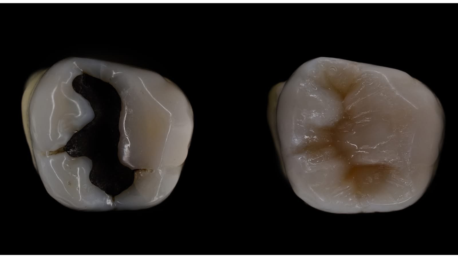 Comparison of a dark filling and a tooth-coloured restoration