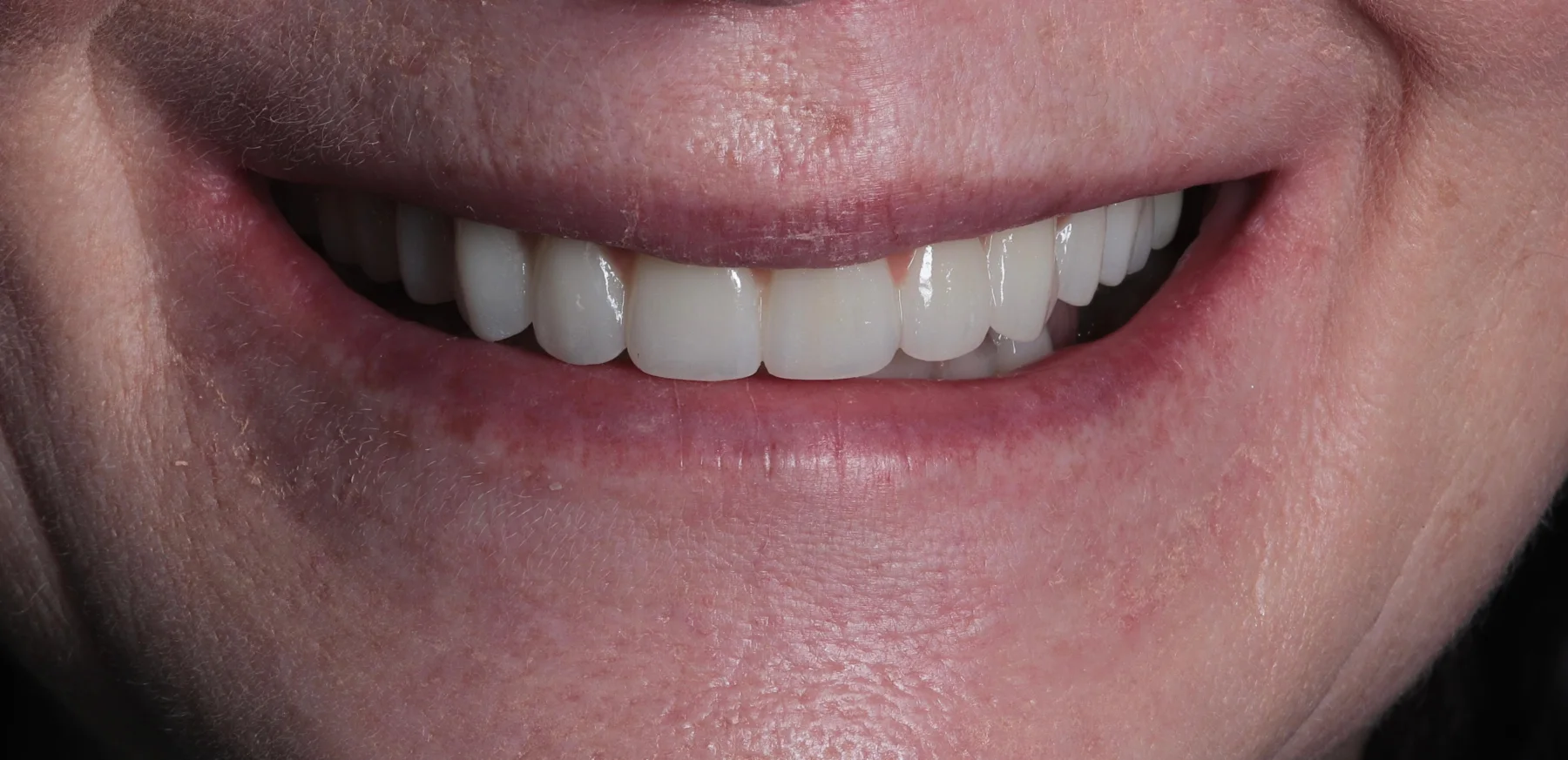 Smile after treatment in a clinical photograph supplied by Smile2Life