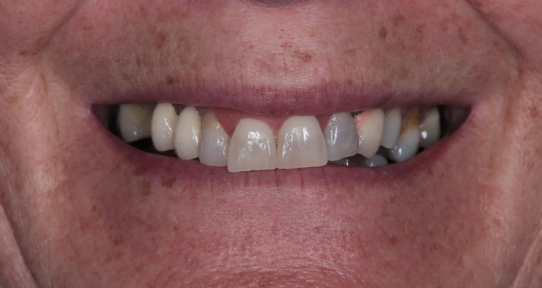 Smile before treatment in a clinical photograph supplied by Smile2Life