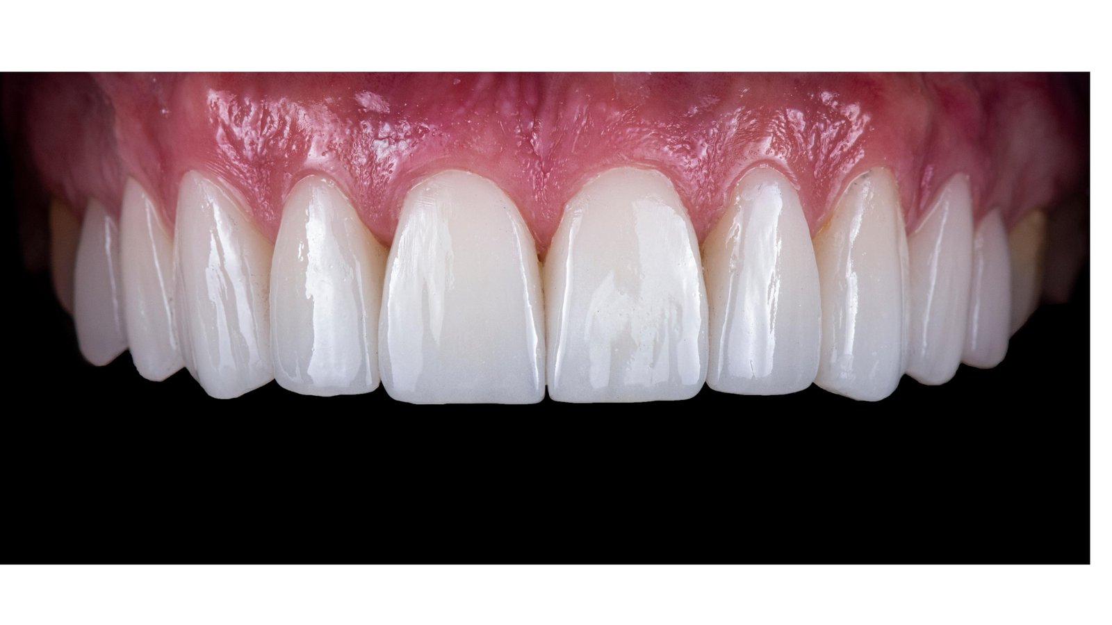 Close clinical photograph of carefully shaped anterior composite restorations