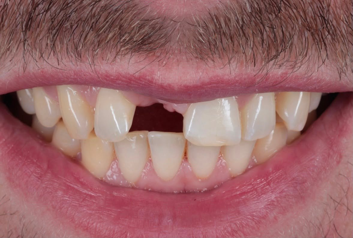 Missing front tooth before dental implant treatment