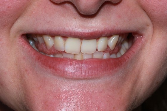 Smile before teeth-straightening treatment