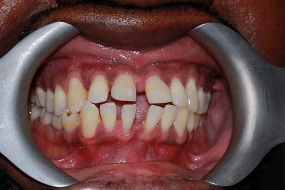 Teeth before a second alignment case