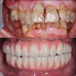 Smiling patient representing restorative planning for worn teeth